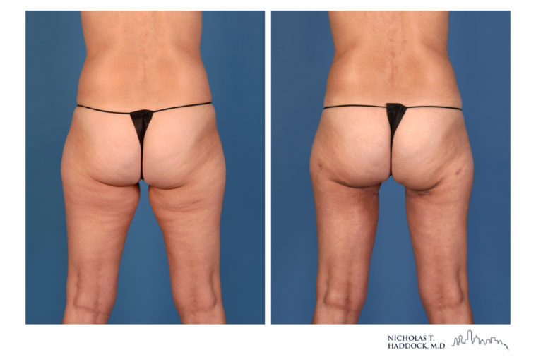 PAP Flap Breast Reconstruction Before and After Photos PAP Flap Breast Reconstruction Before and After Photos