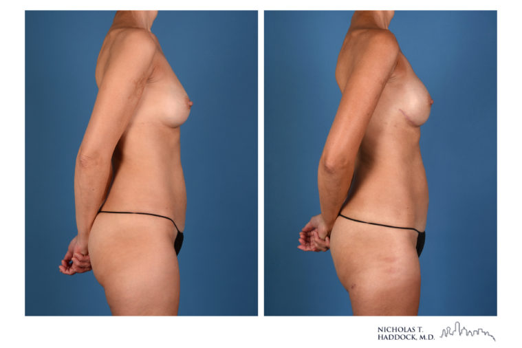 PAP Flap Breast Reconstruction Before and After Photos PAP Flap Breast Reconstruction Before and After Photos