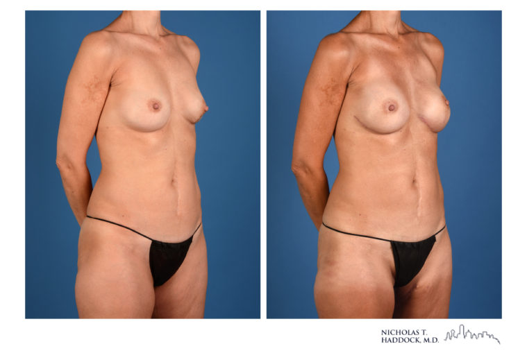 PAP Flap Breast Reconstruction Before and After Photos PAP Flap Breast Reconstruction Before and After Photos