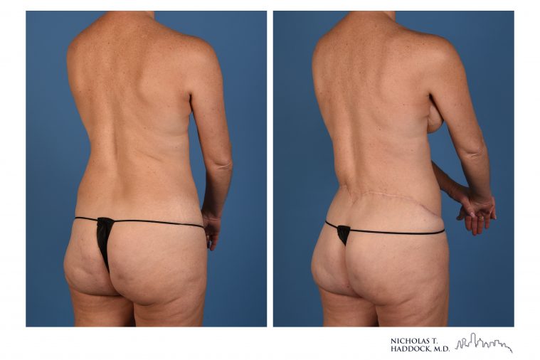 LAP Flap Breast Reconstruction Before and After Photos LAP Flap