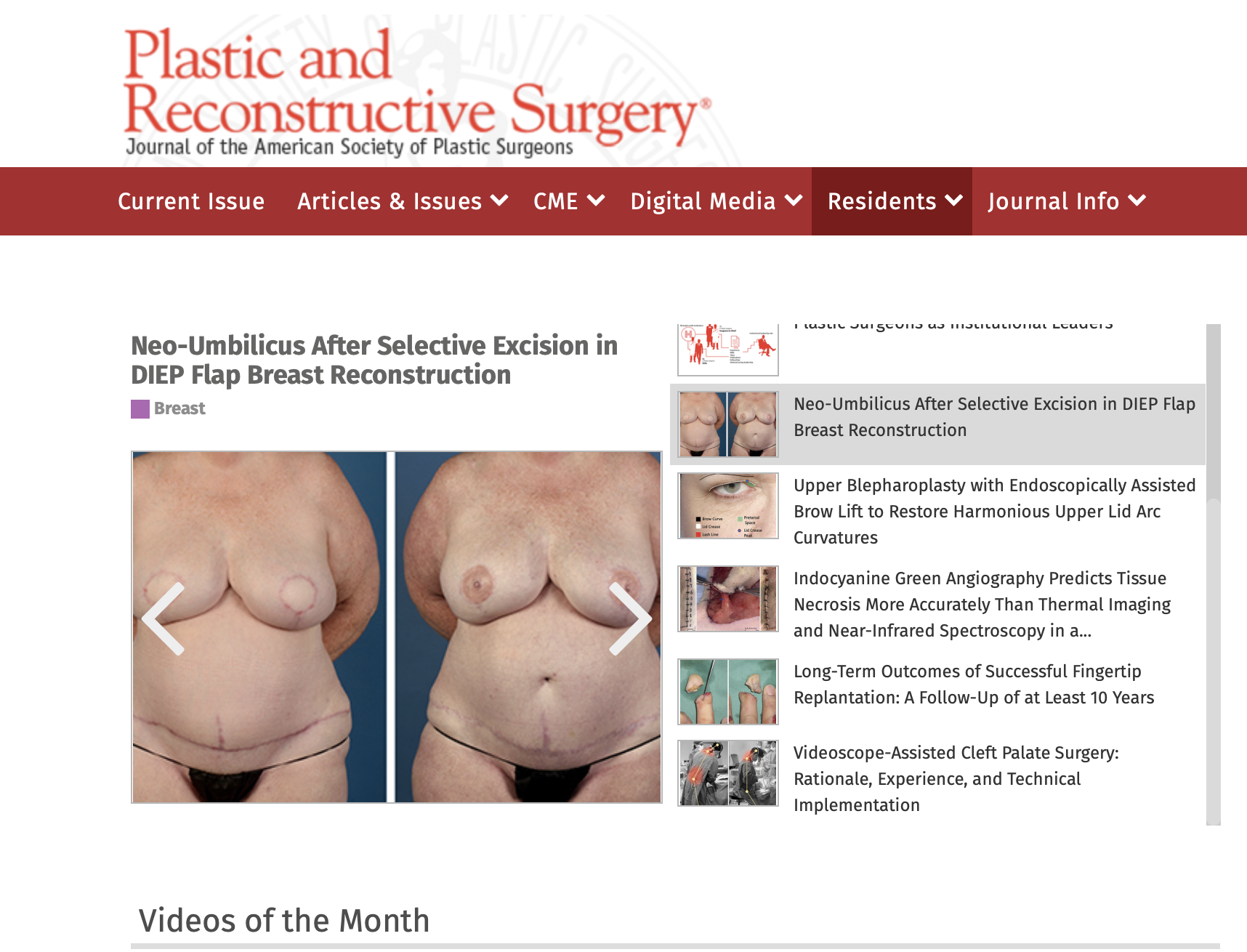Featured image for “New Belly Button Procedure”