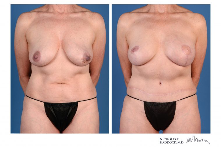 Double DIEP Flap Breast Reconstruction Before and After Photos Double DIEP Flap Breast Reconstruction Before and After Photos