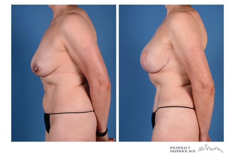 Double DIEP Flap Breast Reconstruction Before and After Photos
