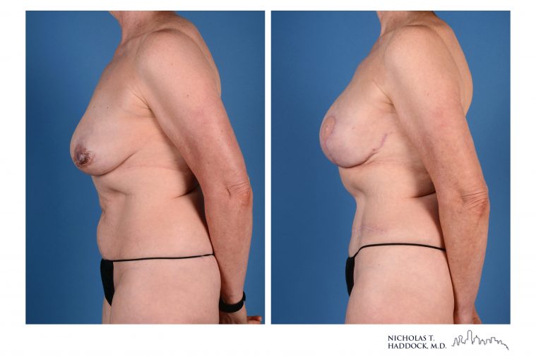 Double DIEP Flap Breast Reconstruction Before and After Photos Double DIEP Flap Breast Reconstruction Before and After Photos