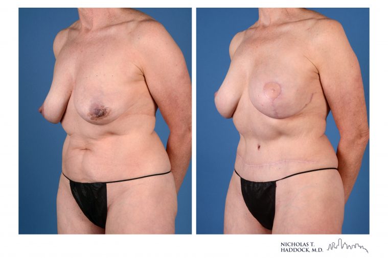 Double DIEP Flap Breast Reconstruction Before and After Photos Double DIEP Flap Breast Reconstruction Before and After Photos