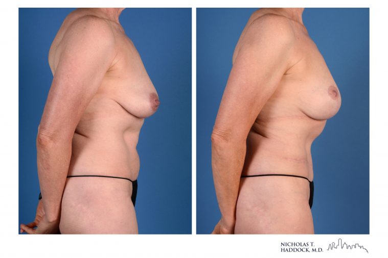 Double DIEP Flap Breast Reconstruction Before and After Photos