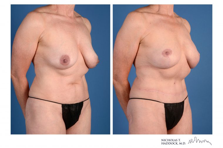 Double DIEP Flap Breast Reconstruction Before and After Photos Double DIEP Flap Breast Reconstruction Before and After Photos