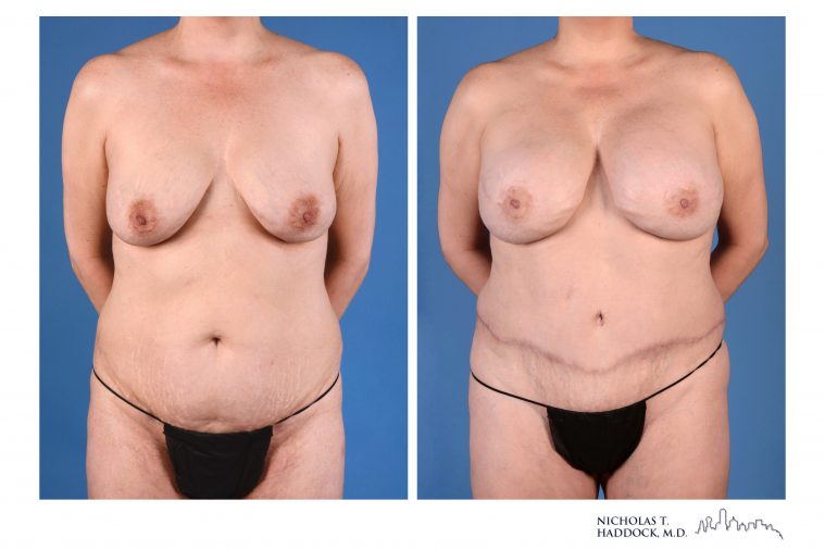 DIEP Flap Breast Reconstruction Before and After Photo