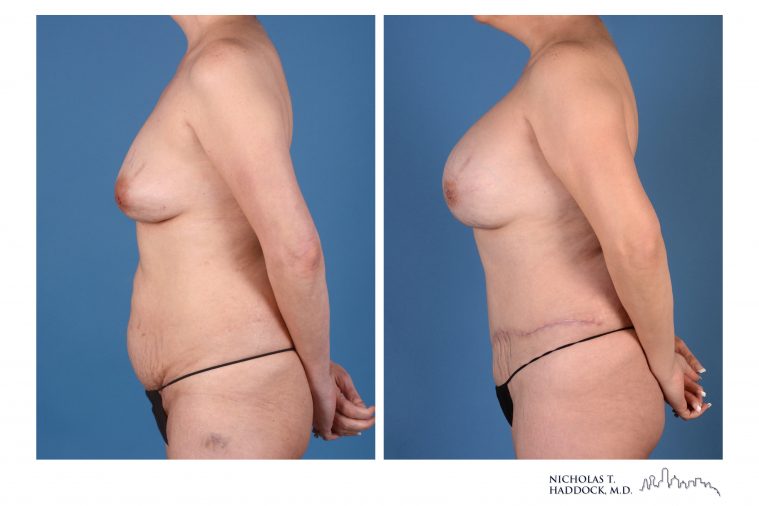 DIEP Flap Breast Reconstruction Before and After Photo DIEP Flap Breast Reconstruction Before and After Photo