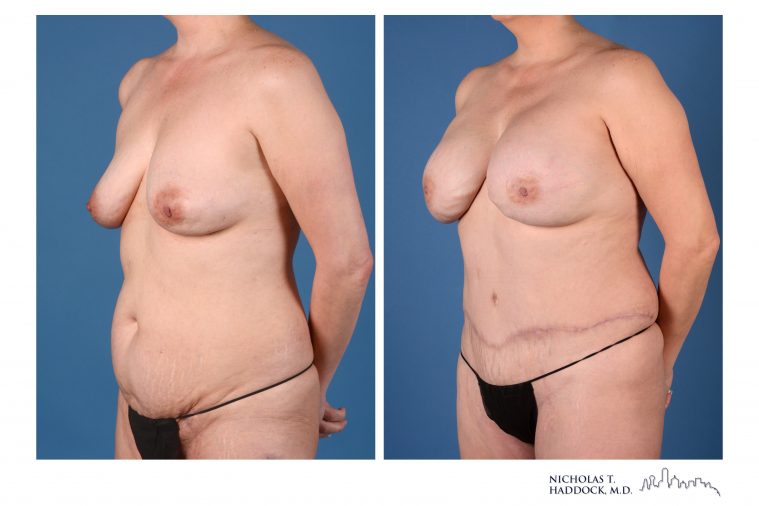 DIEP Flap Breast Reconstruction Before and After Photo