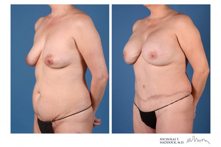 DIEP Flap Breast Reconstruction Before and After Photo DIEP Flap Breast Reconstruction Before and After Photo