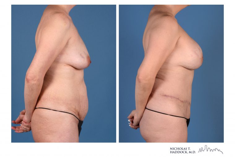 DIEP Flap Breast Reconstruction Before and After Photo DIEP Flap Breast Reconstruction Before and After Photo