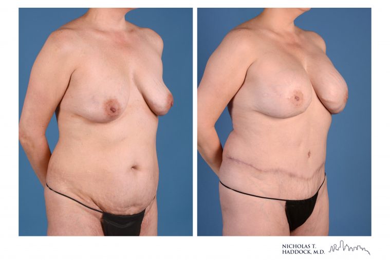 DIEP Flap Breast Reconstruction Before and After Photo DIEP Flap Breast Reconstruction Before and After Photo