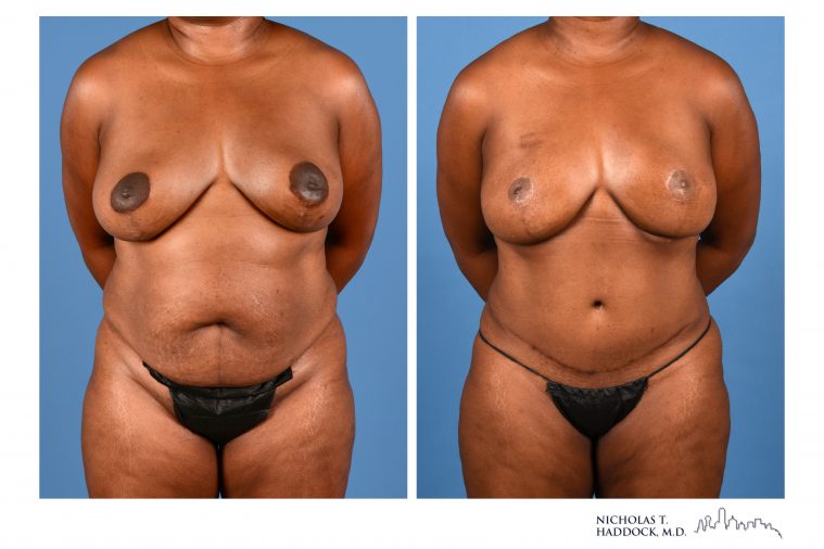 DIEP Flap Breast Reconstruction Before and After Photos DIEP Flap Breast Reconstruction Before and After Photos
