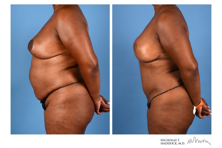 DIEP Flap Breast Reconstruction Before and After Photos DIEP Flap Breast Reconstruction Before and After Photos