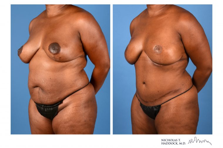 DIEP Flap Breast Reconstruction Before and After Photos
