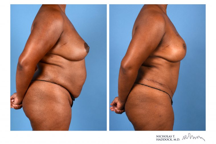 DIEP Flap Breast Reconstruction Before and After Photos DIEP Flap Breast Reconstruction Before and After Photos