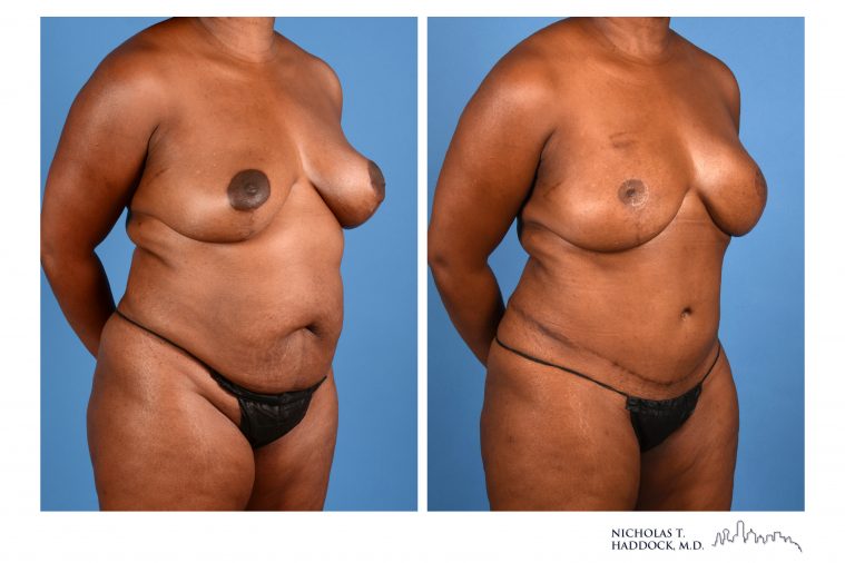 DIEP Flap Breast Reconstruction Before and After Photos DIEP Flap Breast Reconstruction Before and After Photos