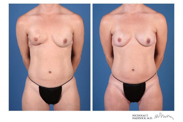 PAP Flap breast reconstruction before and after photos PAP Flap breast reconstruction before and after photos