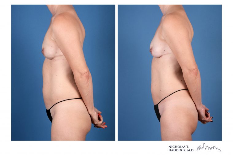 PAP Flap breast reconstruction before and after photos PAP Flap breast reconstruction before and after photos