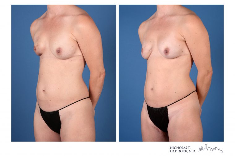 PAP Flap breast reconstruction before and after photos PAP Flap breast reconstruction before and after photos