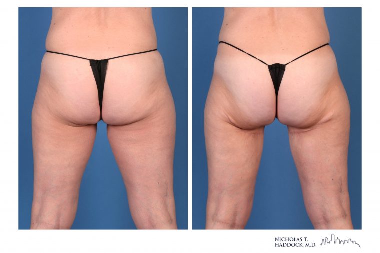 PAP Flap breast reconstruction before and after photos PAP Flap breast reconstruction before and after photos