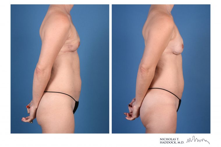 PAP Flap breast reconstruction before and after photos