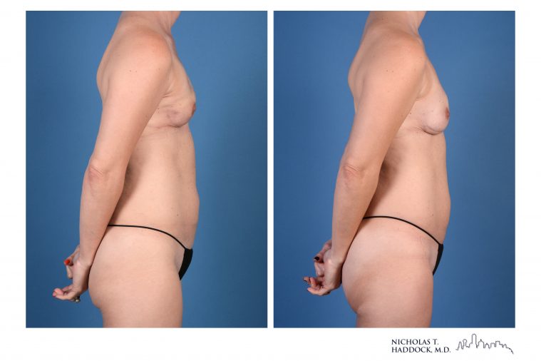 PAP Flap breast reconstruction before and after photos PAP Flap breast reconstruction before and after photos