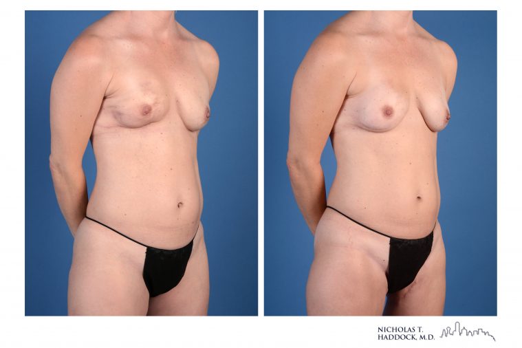PAP Flap breast reconstruction before and after photos