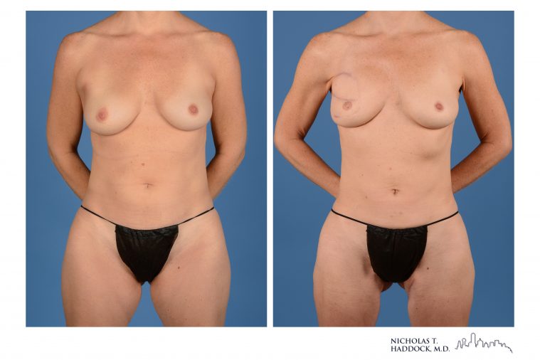 PAP Flap Breast Reconstruction PAP Flap Breast Reconstruction