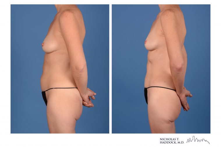 PAP Flap Breast Reconstruction PAP Flap Breast Reconstruction
