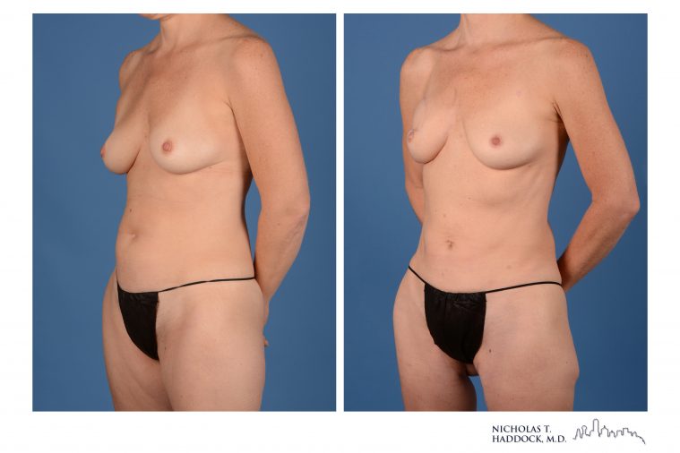 PAP Flap Breast Reconstruction PAP Flap Breast Reconstruction