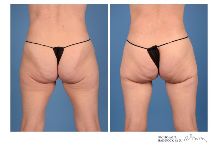 PAP Flap Breast Reconstruction PAP Flap Breast Reconstruction