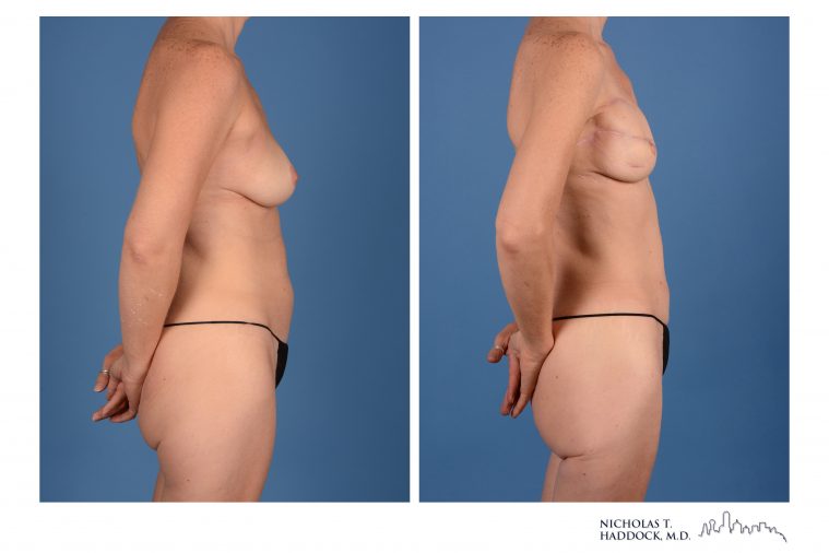 PAP Flap Breast Reconstruction PAP Flap Breast Reconstruction