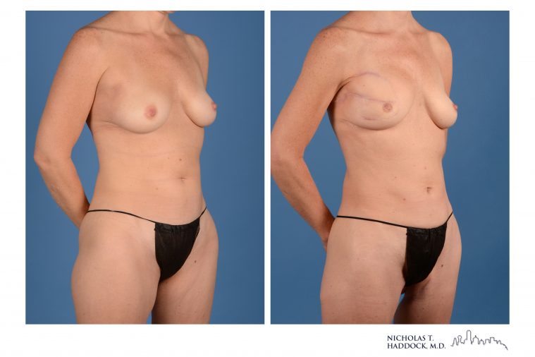 PAP Flap Breast Reconstruction