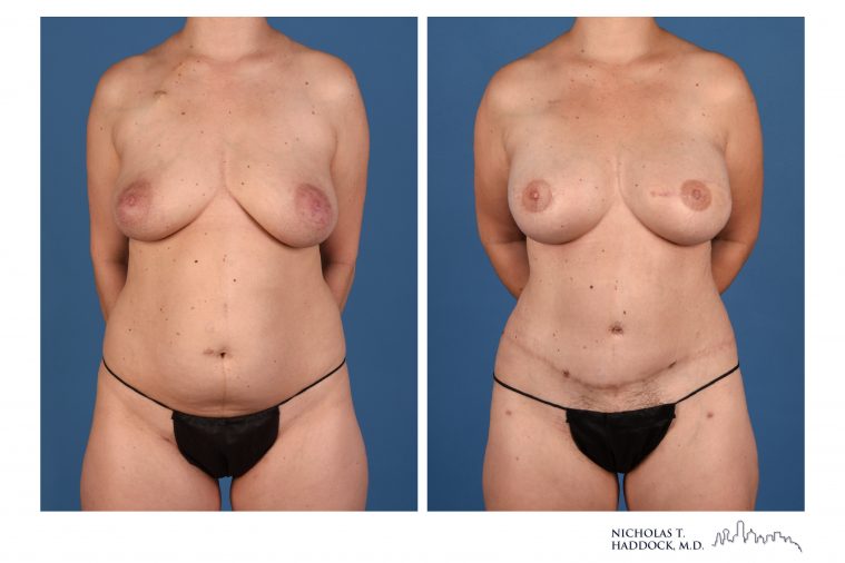 DIEP Flap Breast Reconstruction Before and After Photos DIEP Flap Breast Reconstruction Before and After Photos
