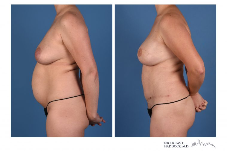 DIEP Flap Breast Reconstruction Before and After Photos