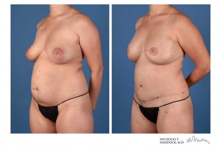 DIEP Flap Breast Reconstruction Before and After Photos DIEP Flap Breast Reconstruction Before and After Photos
