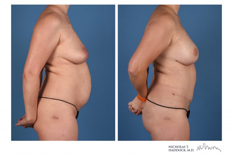 DIEP Flap Breast Reconstruction Before and After Photos DIEP Flap Breast Reconstruction Before and After Photos