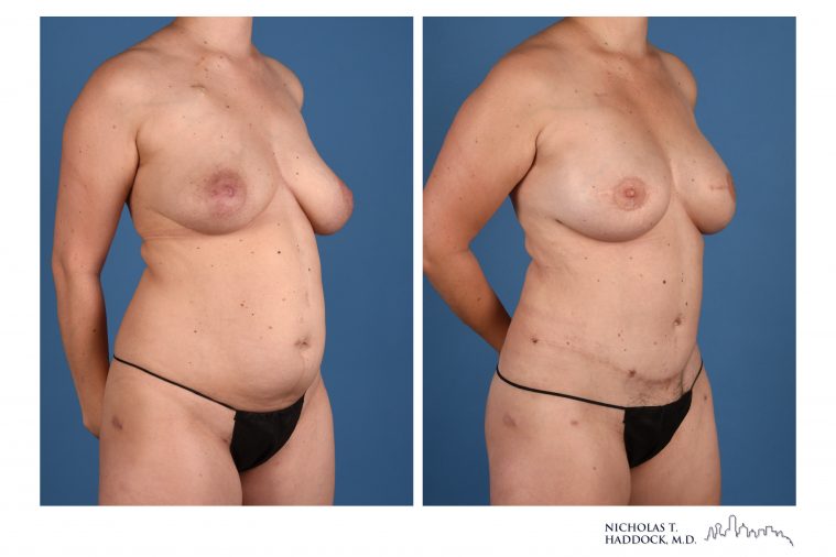 DIEP Flap Breast Reconstruction Before and After Photos DIEP Flap Breast Reconstruction Before and After Photos