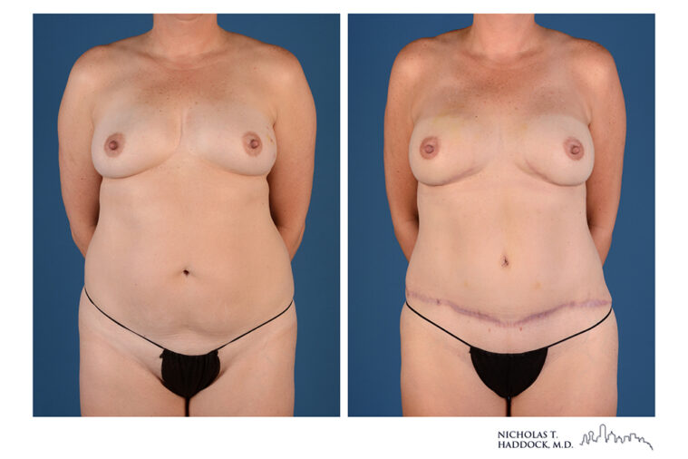 DIEP Flap Before and After Photo DIEP Flap Before and After Photo