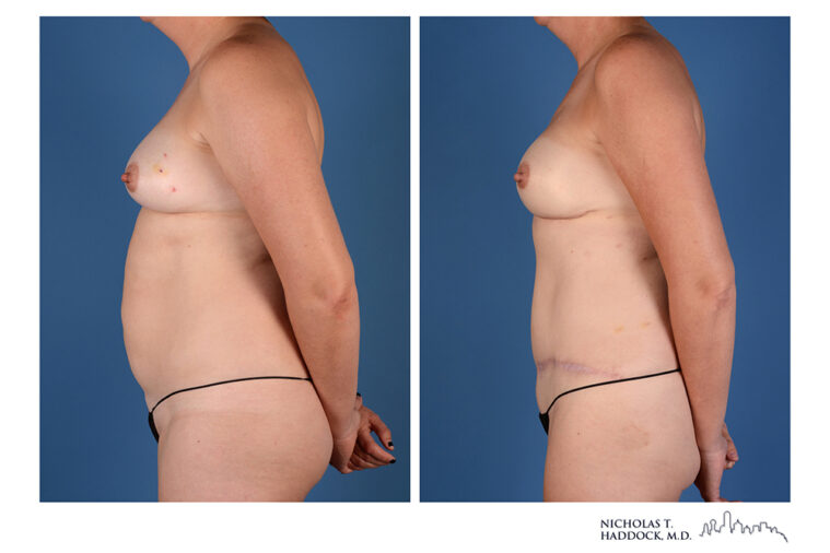 DIEP Flap Before and After Photo DIEP Flap Before and After Photo