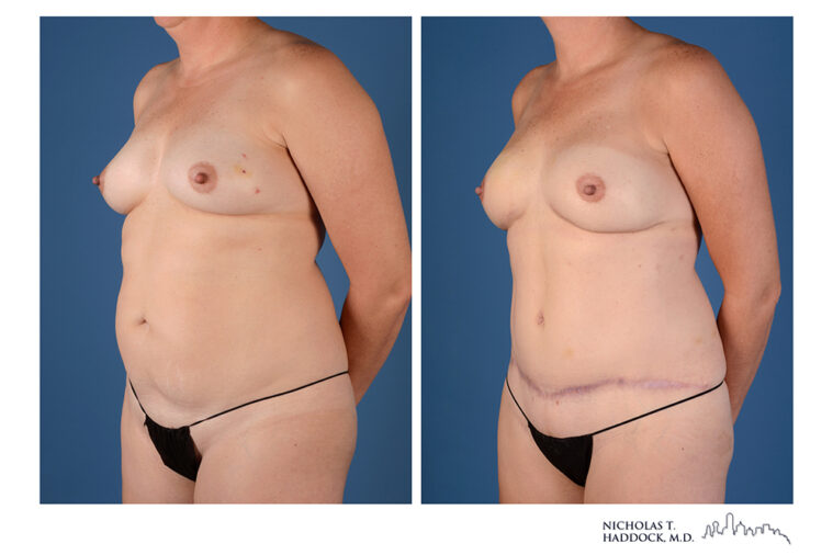 DIEP Flap Before and After Photo DIEP Flap Before and After Photo