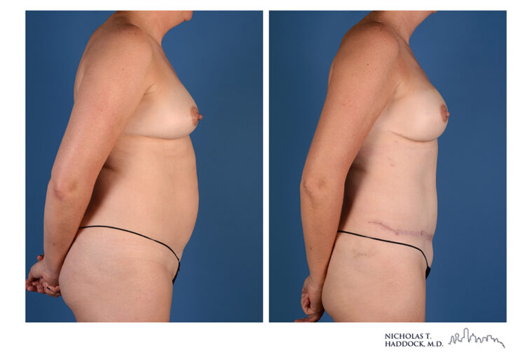 DIEP Flap Before and After Photo DIEP Flap Before and After Photo