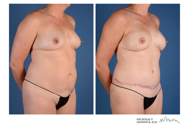 DIEP Flap Before and After Photo DIEP Flap Before and After Photo
