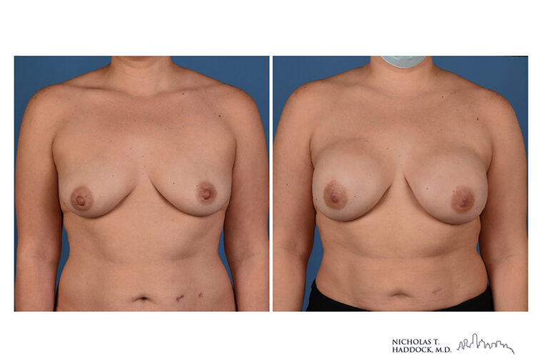 Implant Breast Reconstruction Before and After Photo Implant Breast Reconstruction Before and After Photo