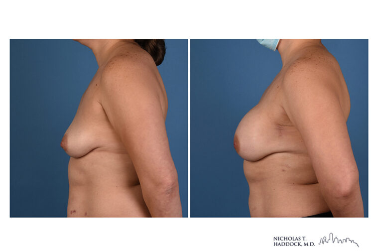 Implant Breast Reconstruction Before and After Photo Implant Breast Reconstruction Before and After Photo