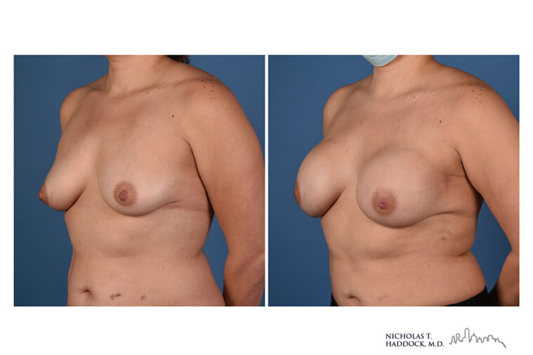 Implant Breast Reconstruction Before and After Photo Implant Breast Reconstruction Before and After Photo