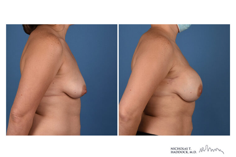 Implant Breast Reconstruction Before and After Photo Implant Breast Reconstruction Before and After Photo