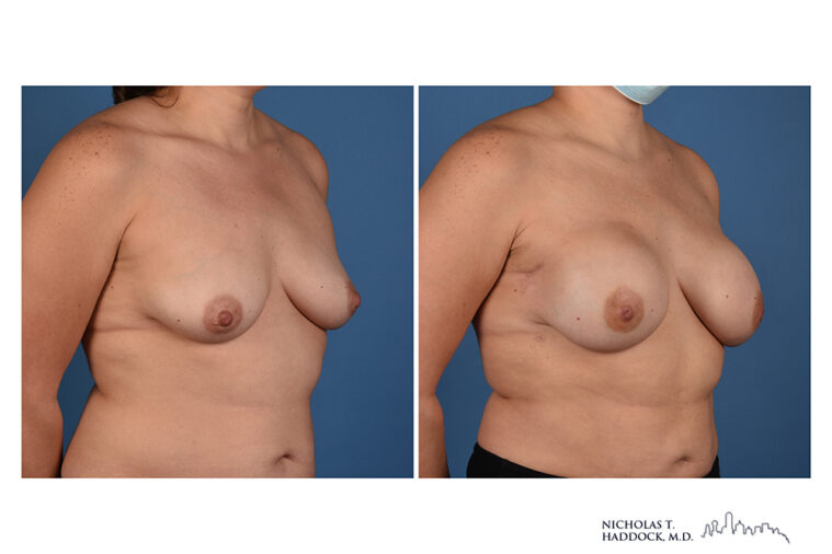 Implant Breast Reconstruction Before and After Photo Implant Breast Reconstruction Before and After Photo